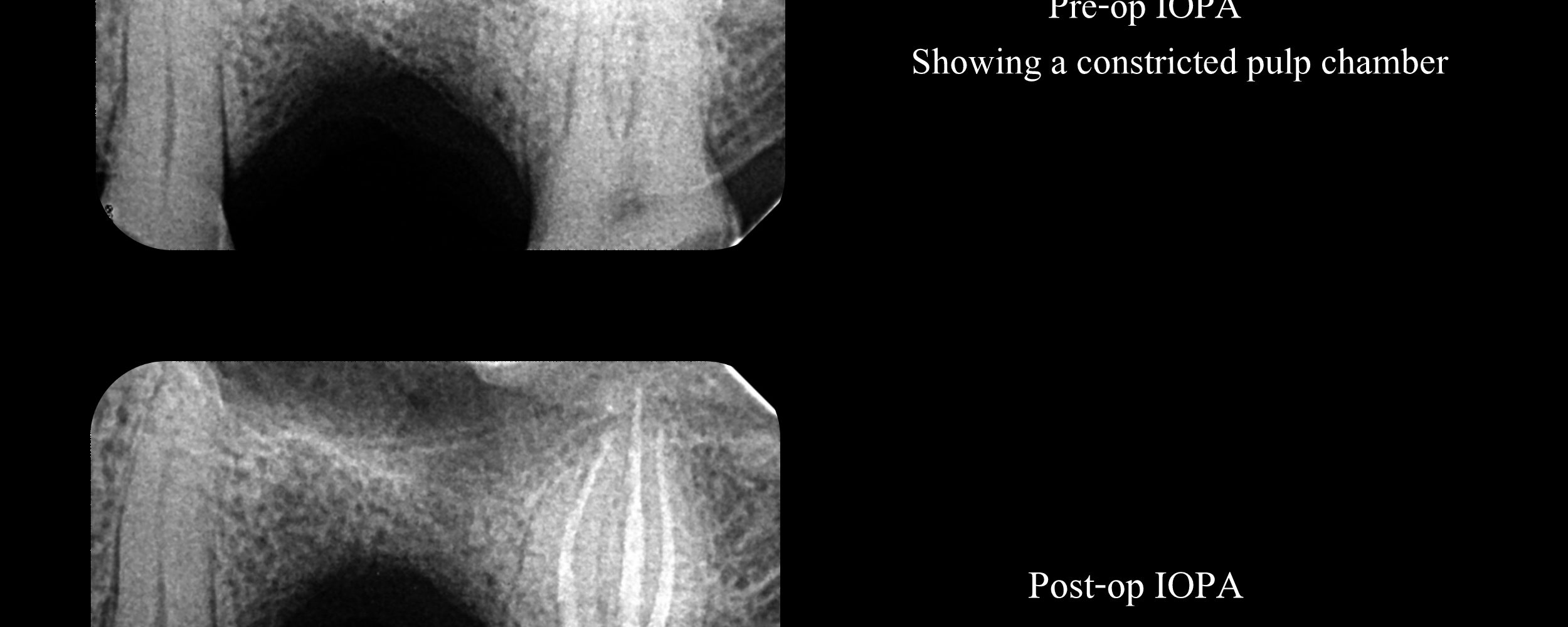 #15 Pulpitis – Canal Projection