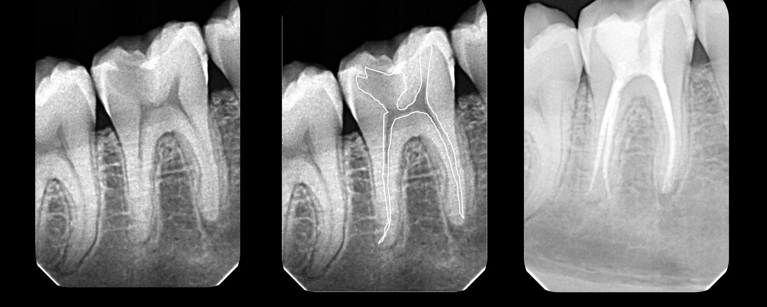 Desi- Image guided endodontics