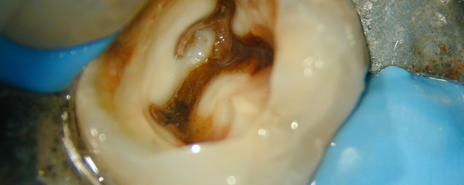 Caries driven access