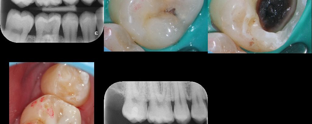 Selective Caries Removal