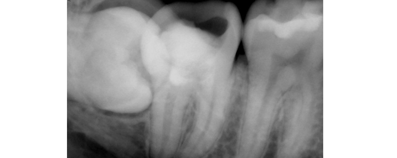 Apexogenesis + Selective Endo