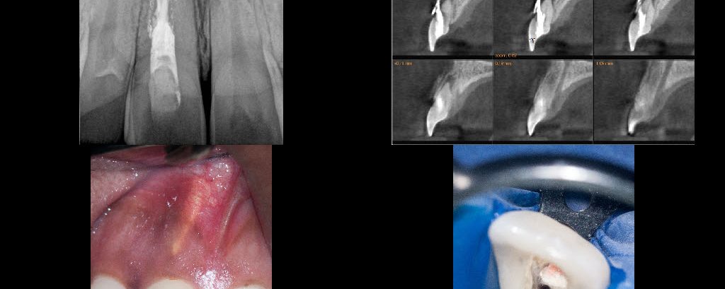 Perforation management
