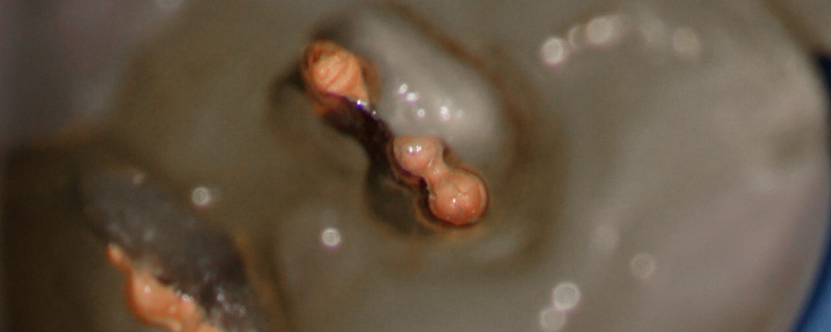 #19 RCT – 3 Mesial Anatomy – Truss Access