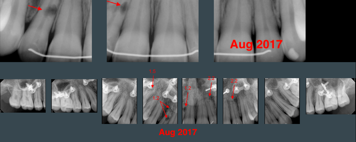 Multiple External Apical Root Resorption