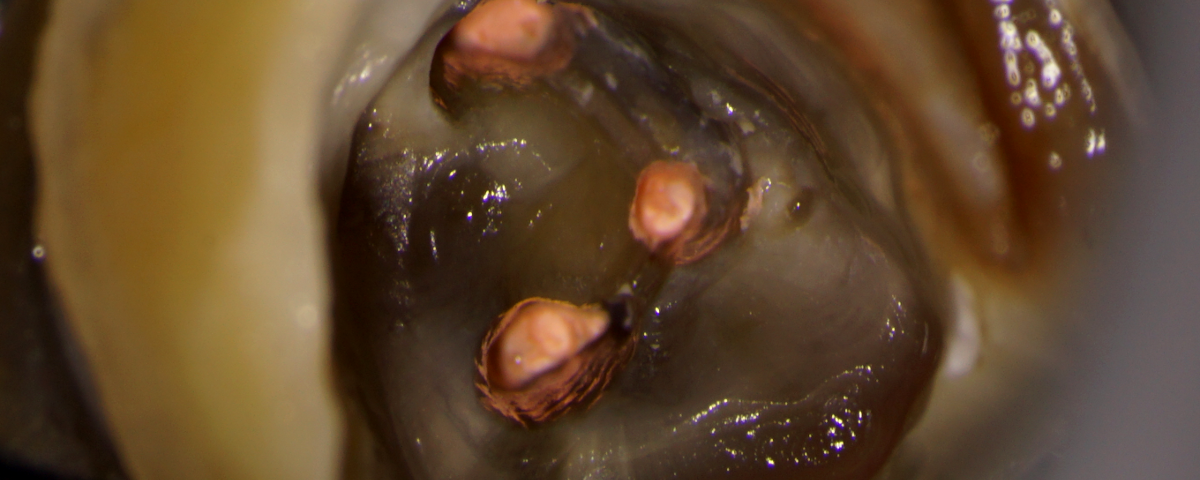 #31 – C shaped Anatomy – Separated file&nbsp;