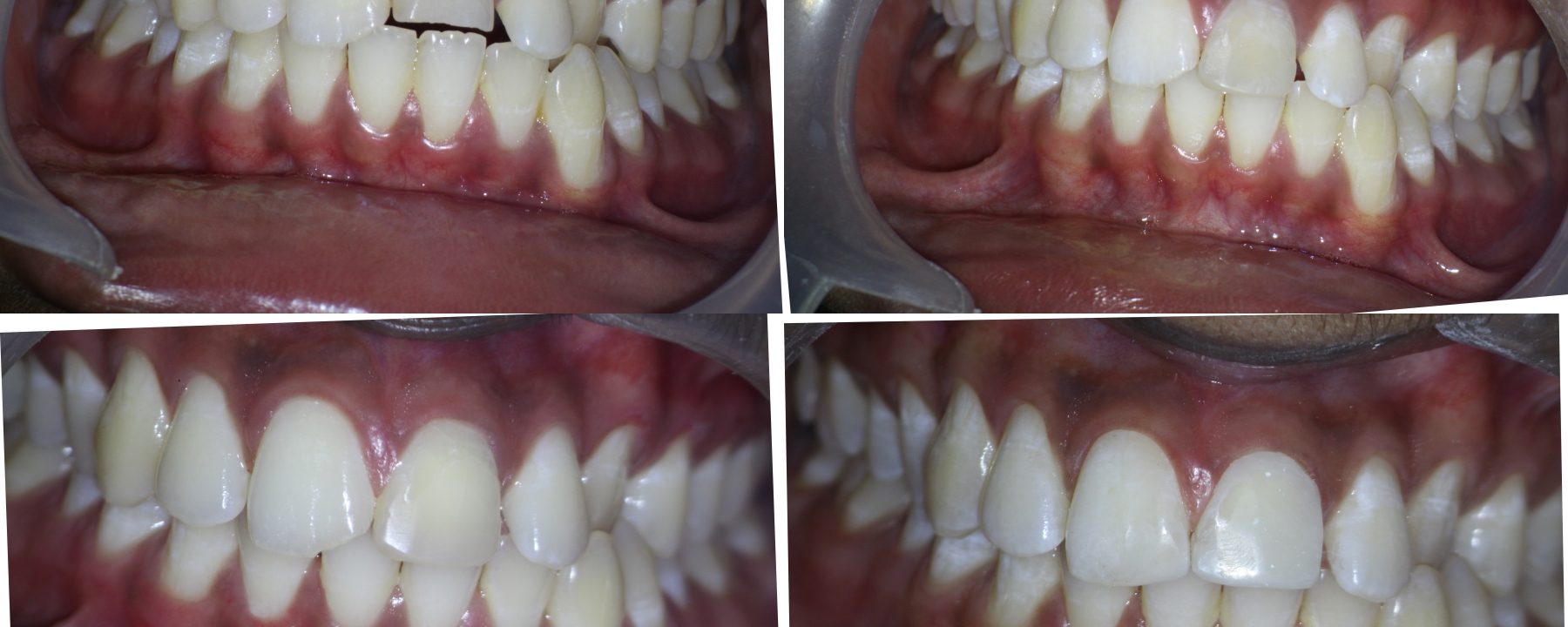 Non-vital  fractured #9 with PAP