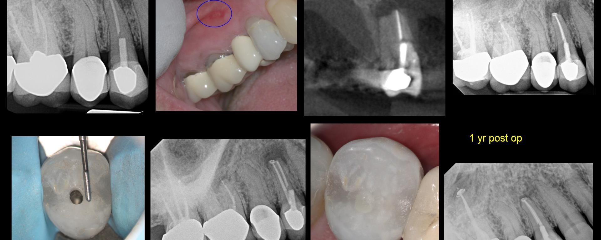 MIE: Untreated pal canal