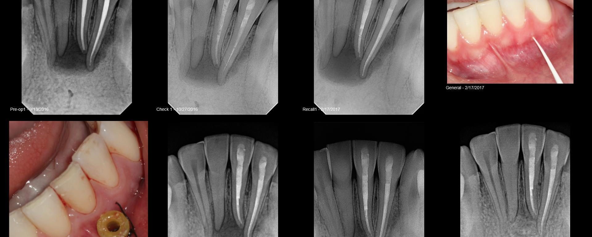 Pt presented with persistent sinus tract on B