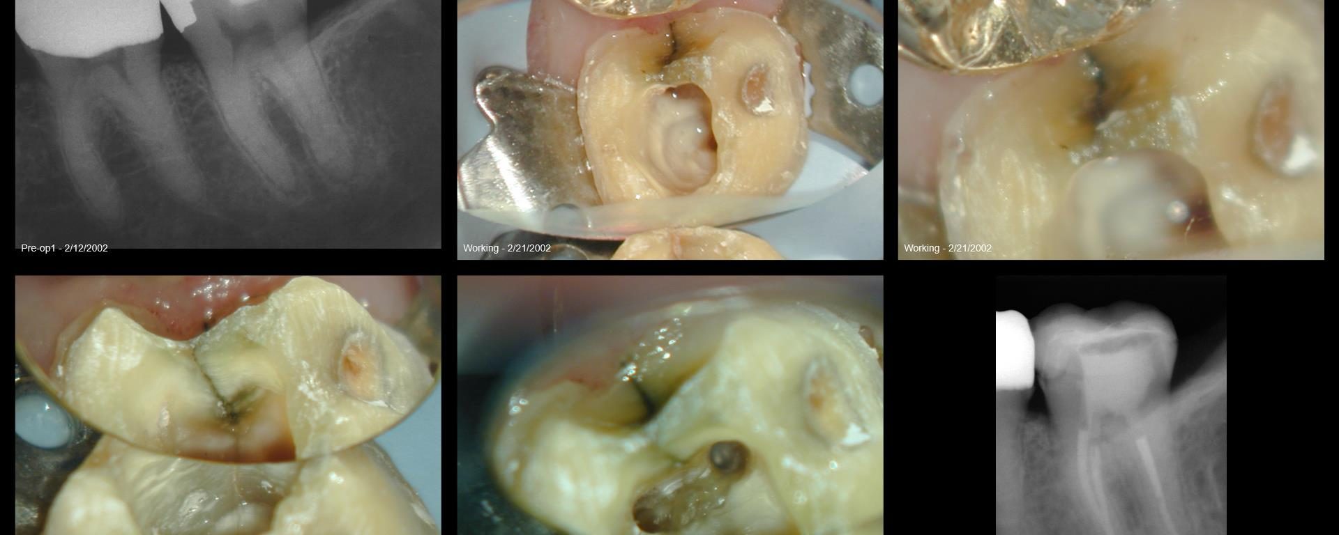 16 yr recall os a fracture