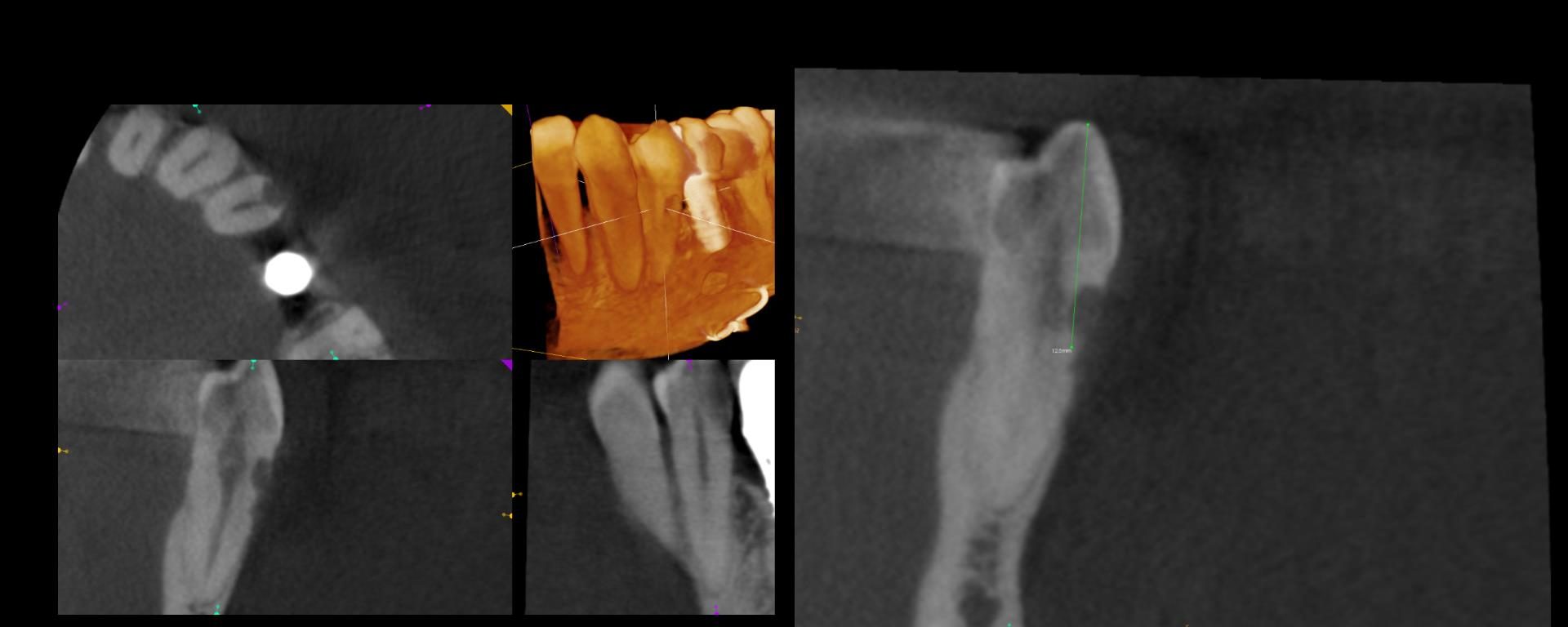 3 yr ECIR repair recall