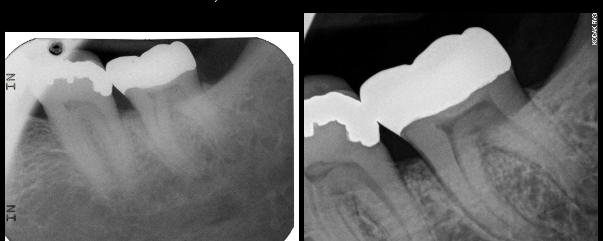 How to avoid fractured roots