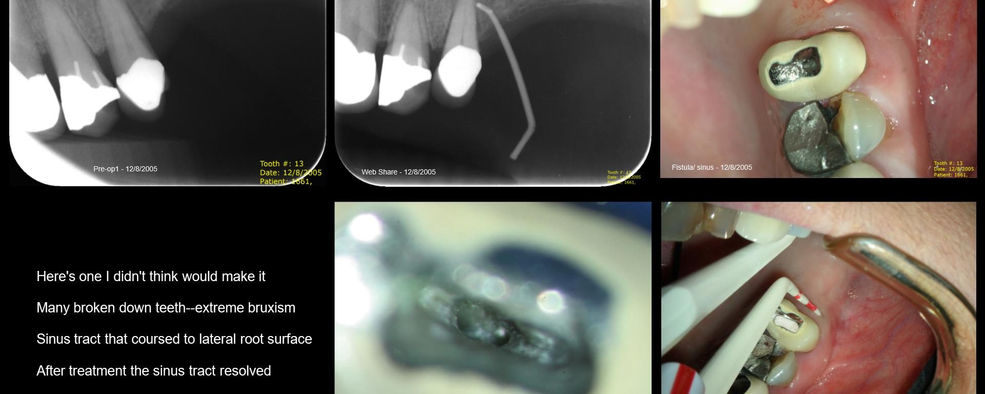 13 years on a tooth which shouldn’t have made it