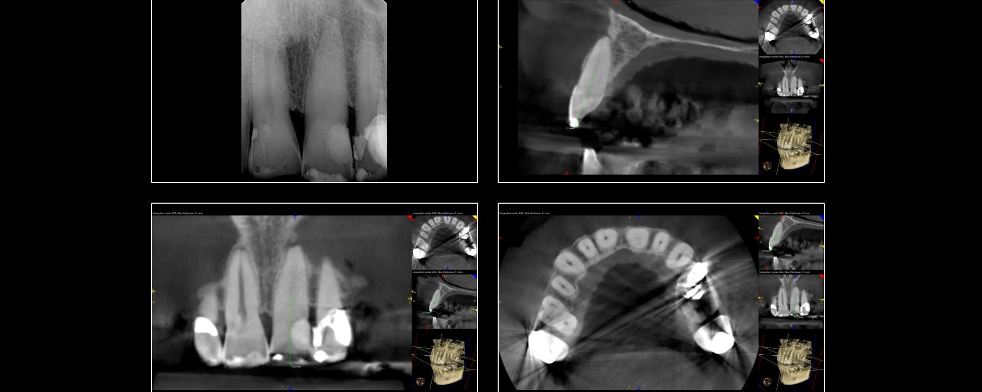 Dynamically Guided Endodontic Access