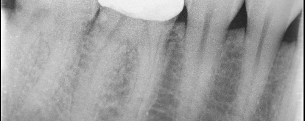 1-Year Follow-up Conservative Access.