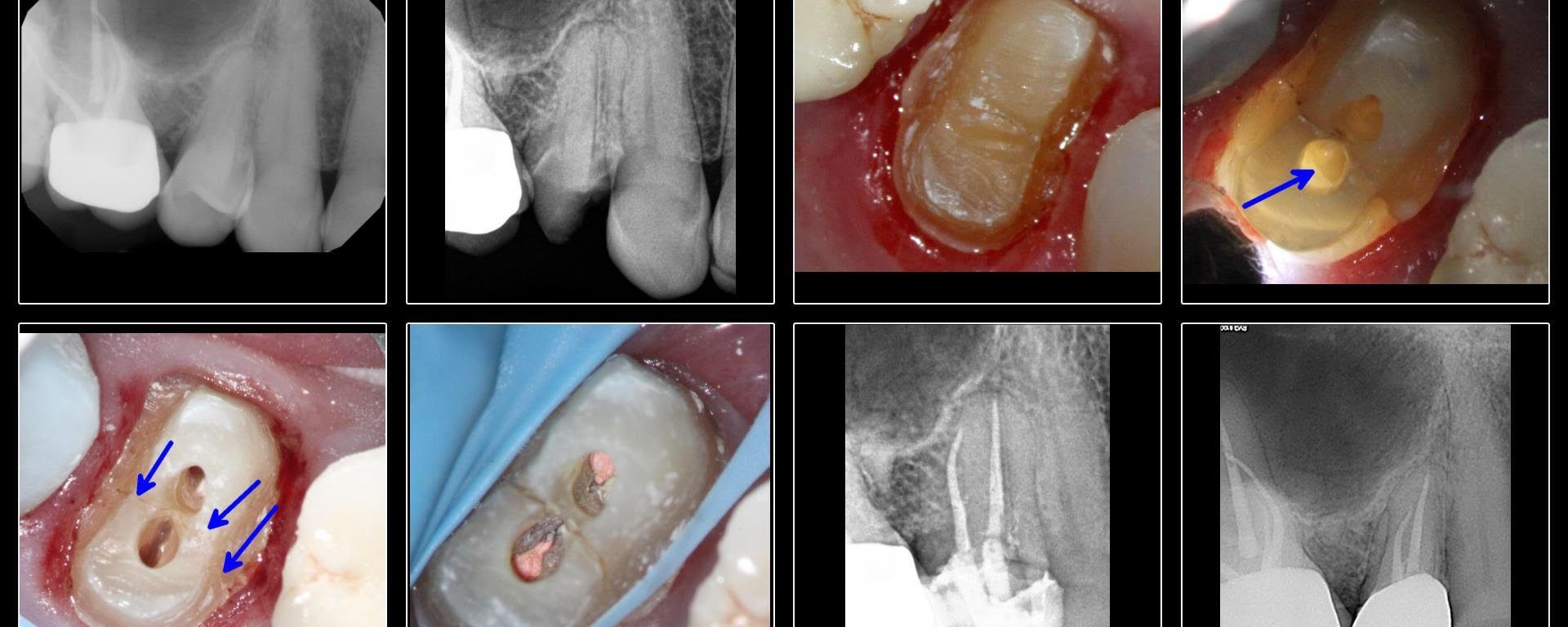 Fractured Bicuspid/MIE