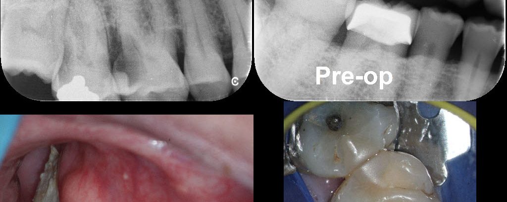 Class II Restorations: Tackling the Challenging Cases