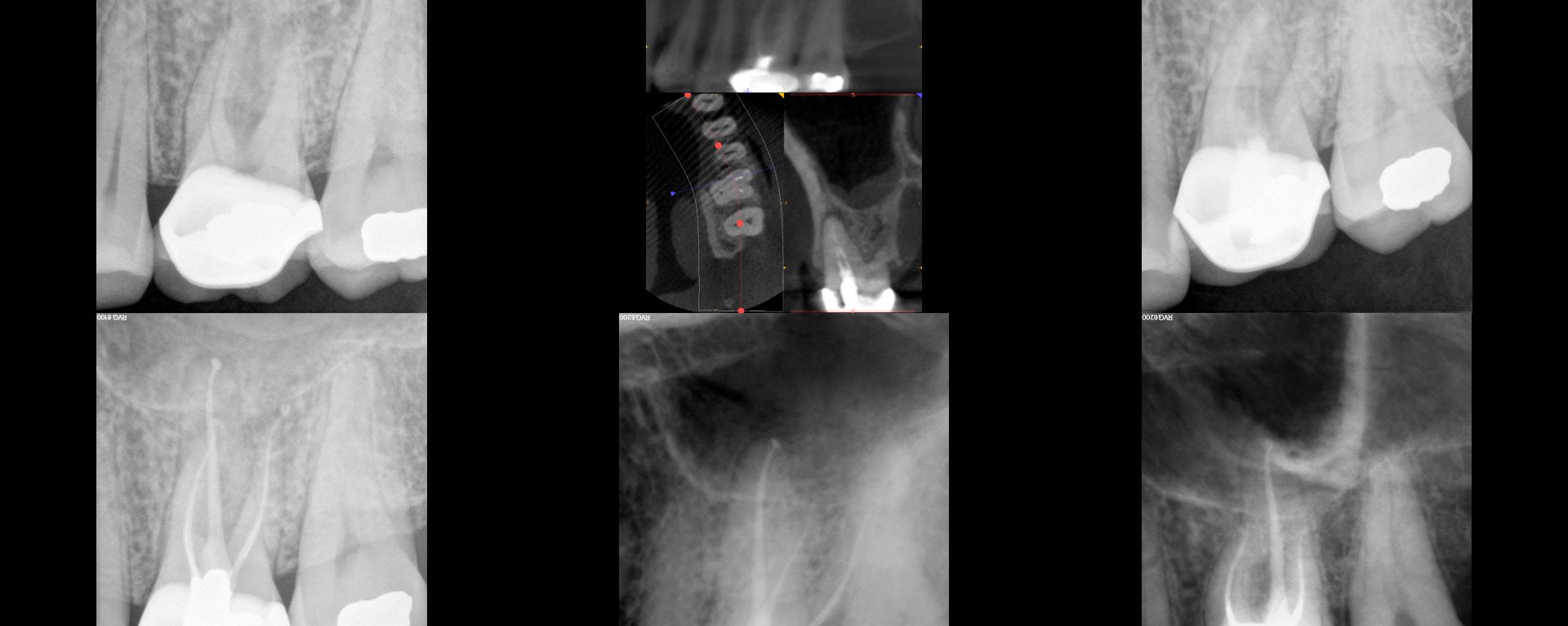 Three year followup on NSRCT with amalgam crown repair