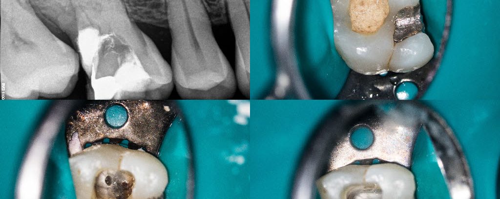 Amalgam restorations