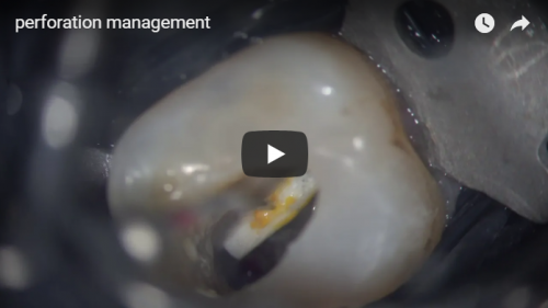 perforation-management