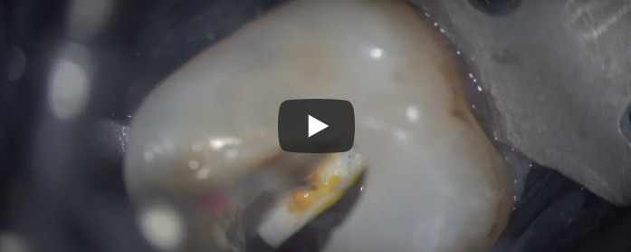 Perforation management