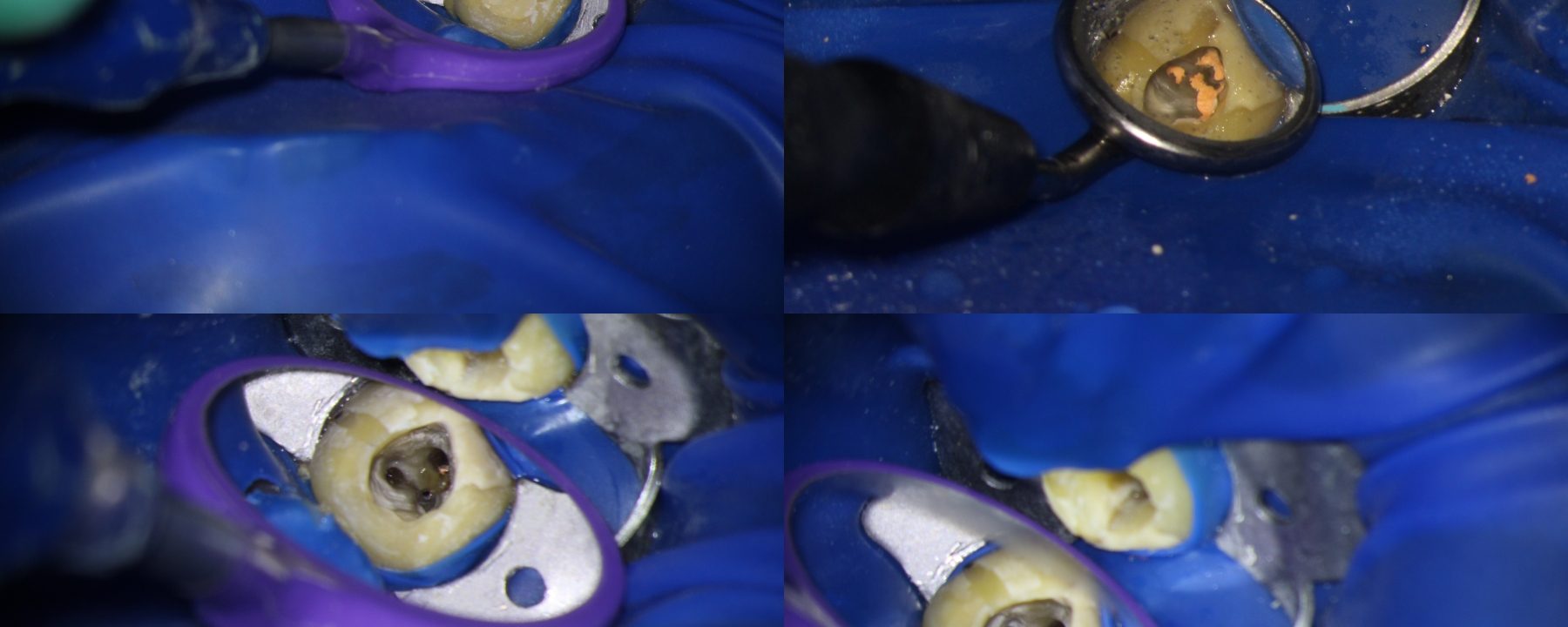 Perforation management