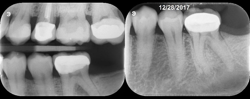 Just a 6-Month Follow-up