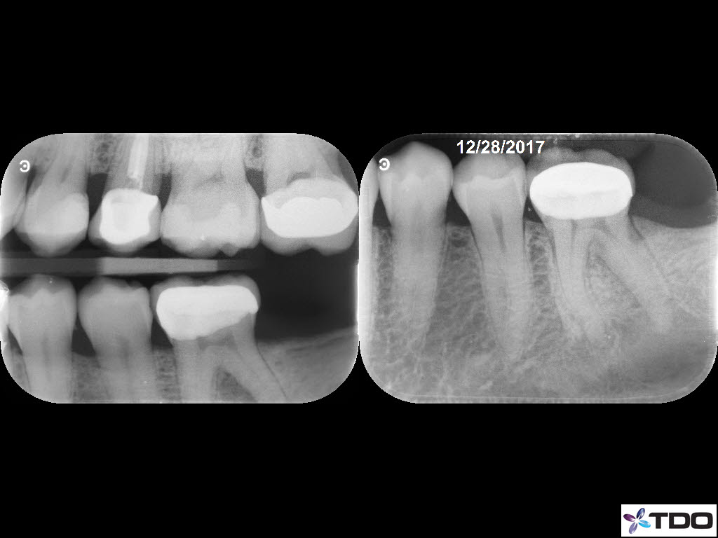 #19 Necrotic Drainage 6mo 1
