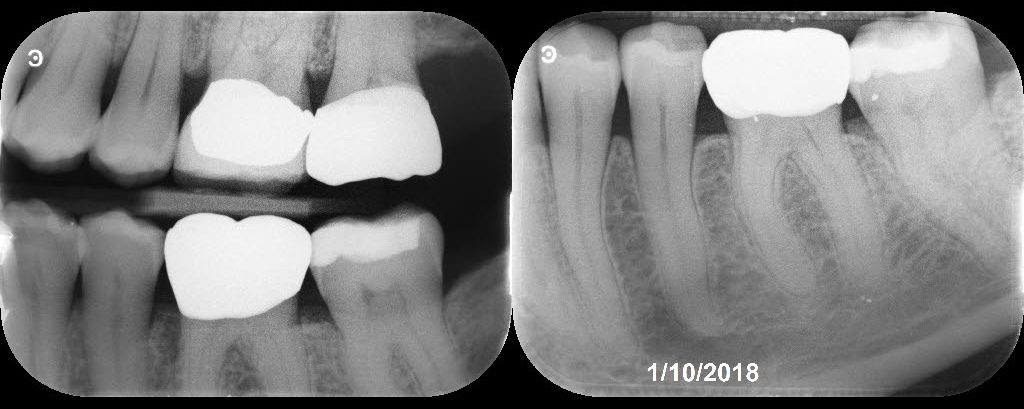 Another 6-Month Follow-up