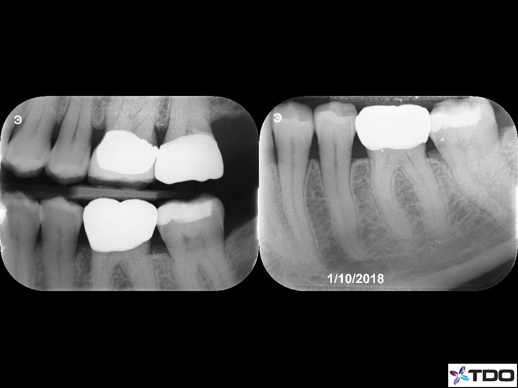 6 canals Hyperemic 6mo FU 1