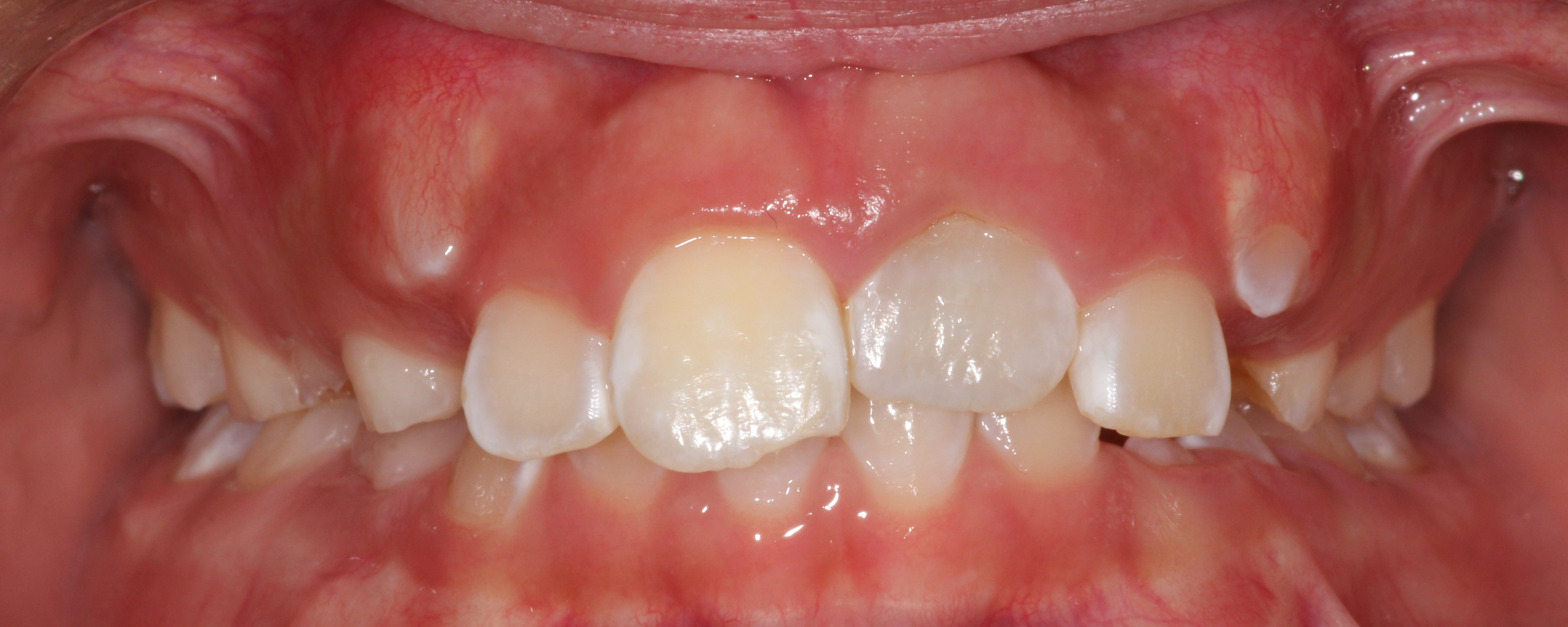 9yo girl, #9 ankylosis and discoloration