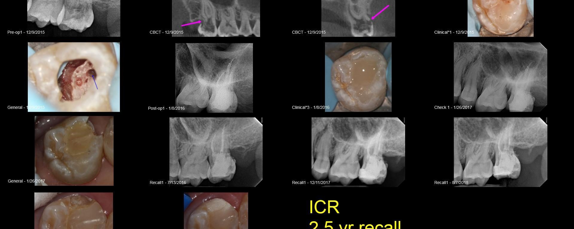 ICR…crown or no crown?