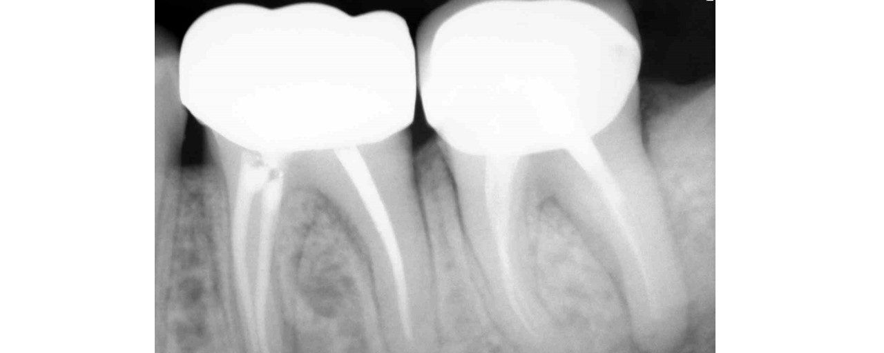 Selective Re-treatment of Distal Root