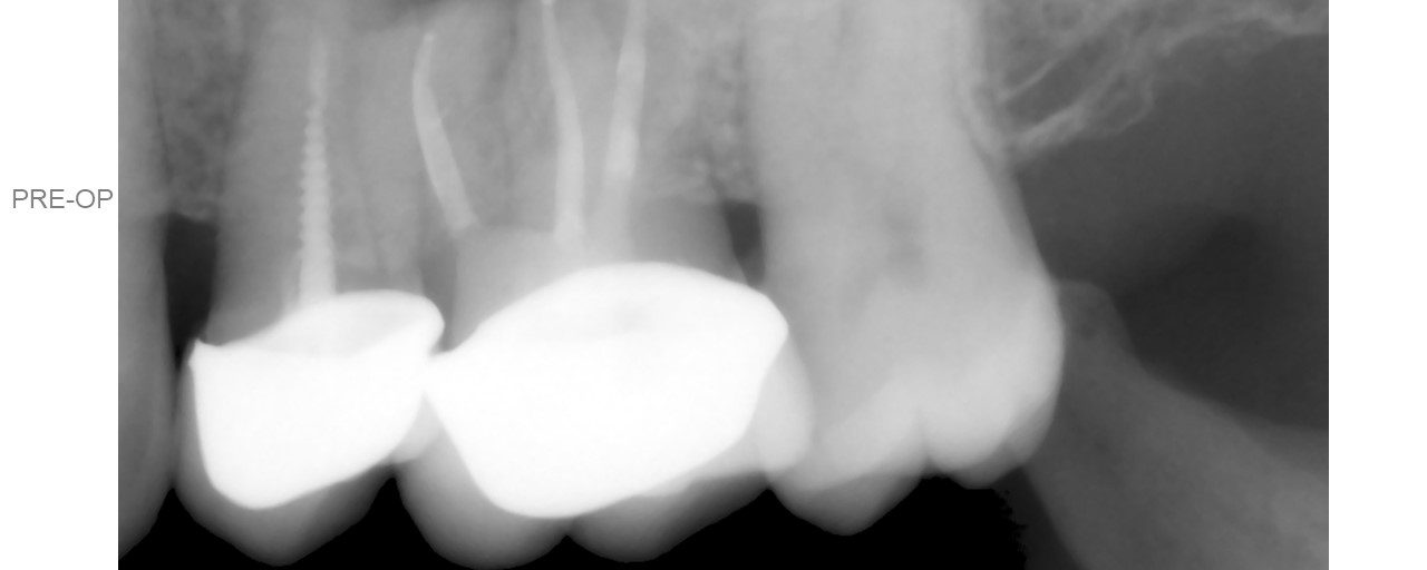 Selective Re-treat of Missed MB2