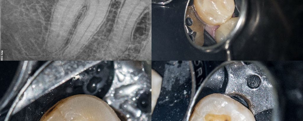 Cracked lower second molar