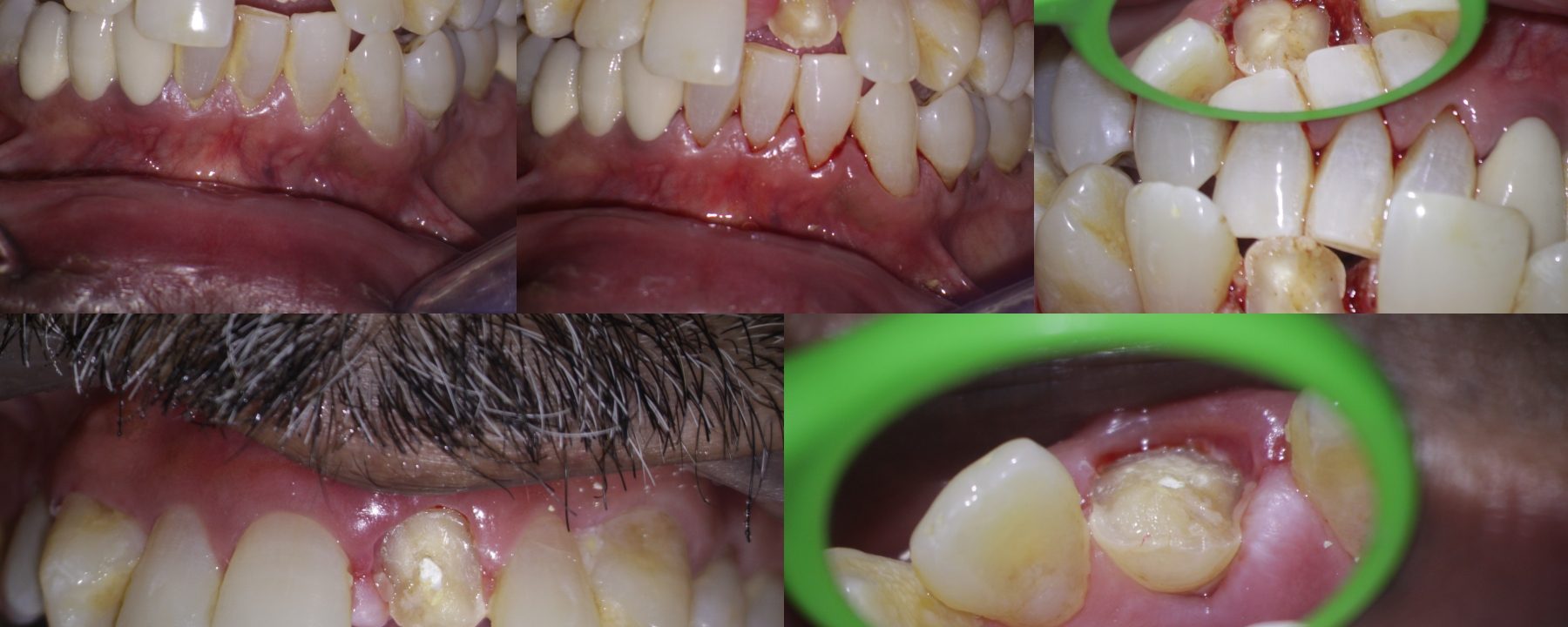 Crown fracture extending sub-gingival