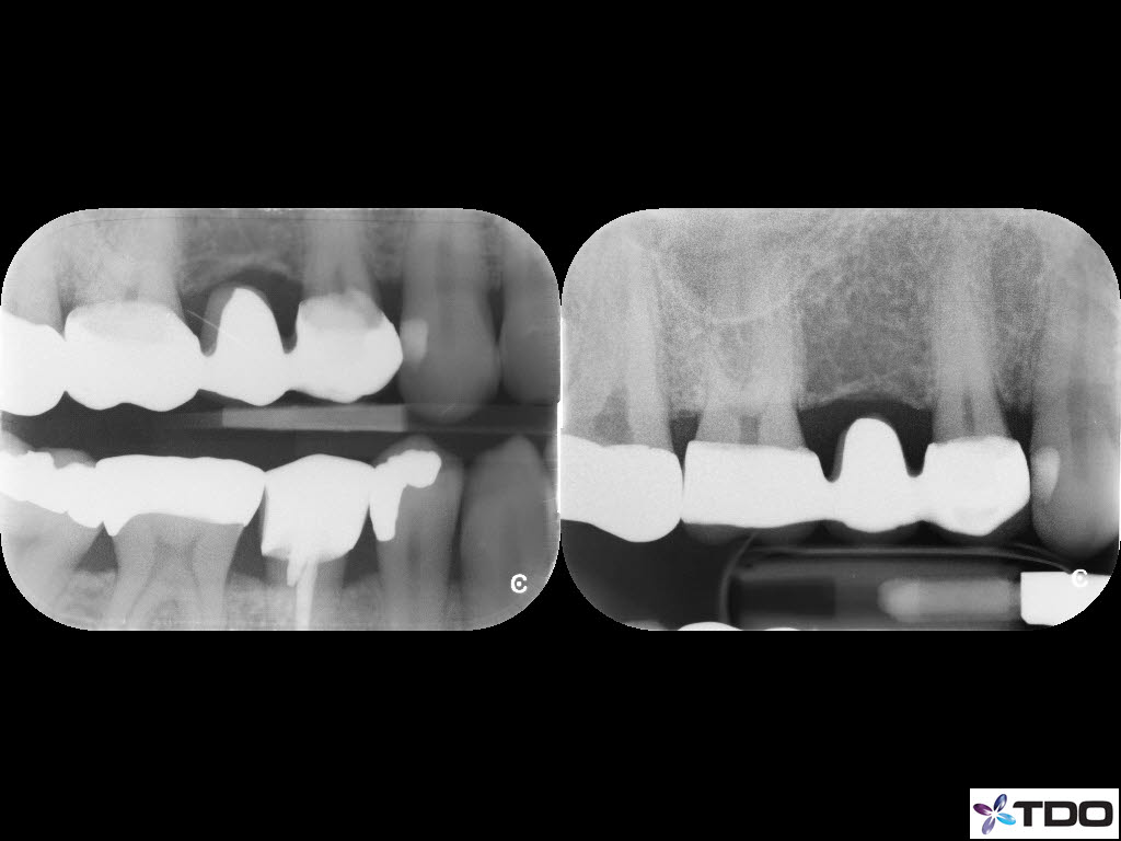 6mo FU Partially Vital 1