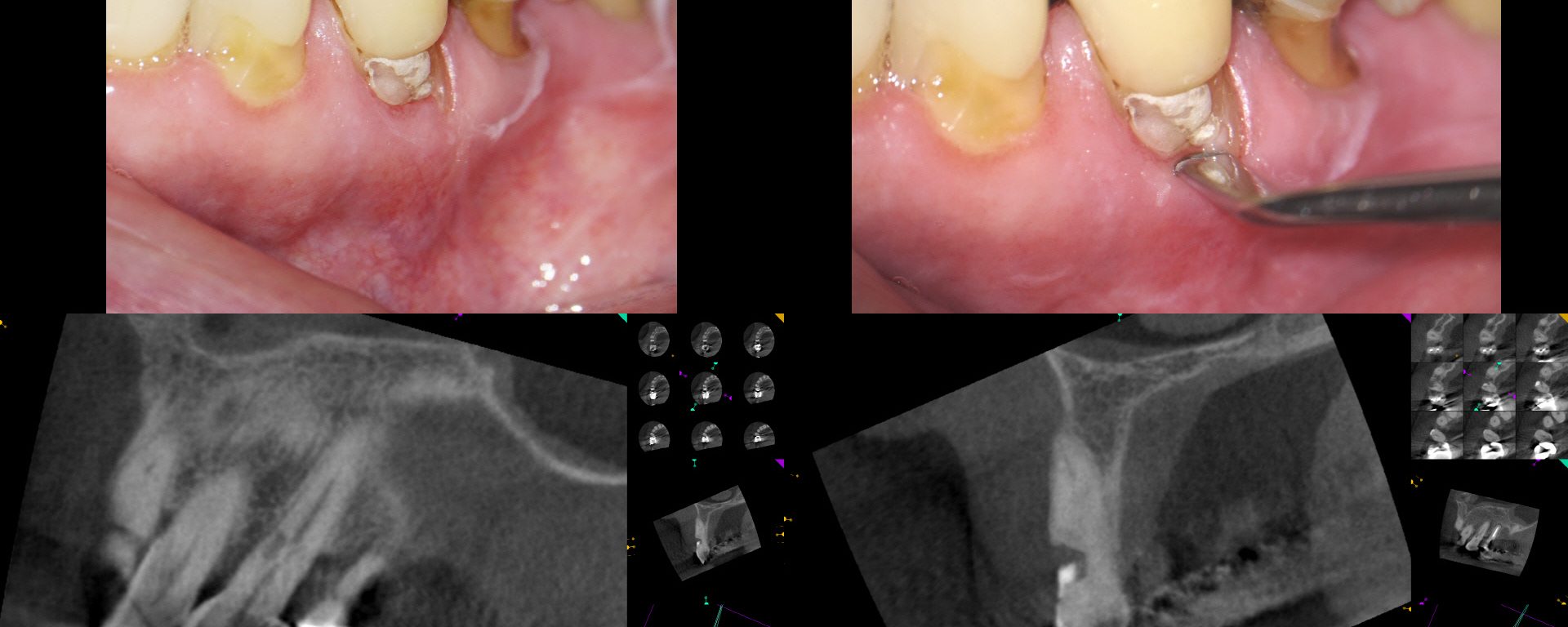External Cervical Resorption