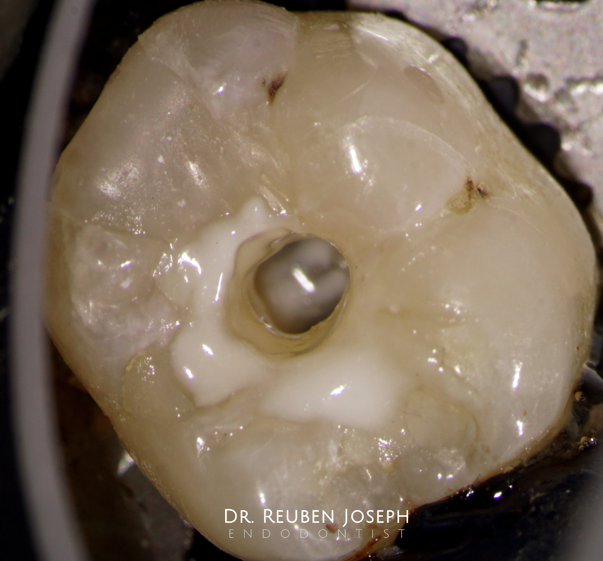 37 RCT done in 2 visits TDO University